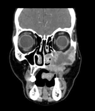 Neurofibroma of sinus maxillae